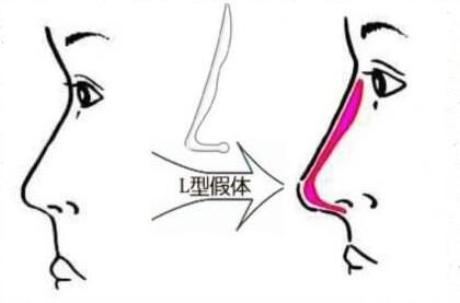 硅胶隆鼻副作用二:手术后存在假体不稳定 硅胶隆鼻副作用二:手术后存在假体不稳定