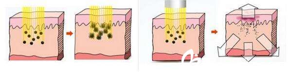 激光祛斑手术原理