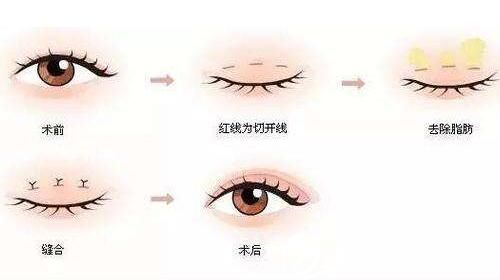 韩式三点定位双眼皮手术示意图