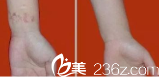 北京米兰柏羽丽都去疤实例参考