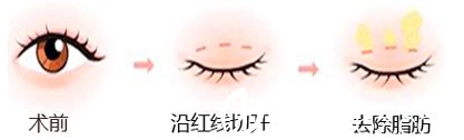 韩式重睑术手术方法图解 韩式重睑术手术方法图解