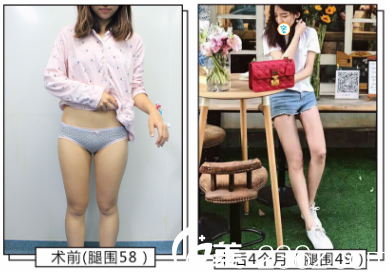 成都艾米丽大腿吸脂术后4个月对比