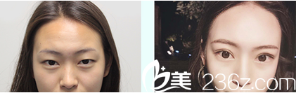 成都艾米丽双眼皮手术前后对比