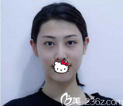 自体脂肪面部填充术前照 自体脂肪面部填充术前照