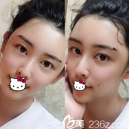 面部脂肪填充术后2天恢复情况 面部脂肪填充术后2天恢复情况