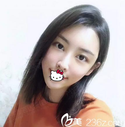 美莱长效脂肪胶术后效果 美莱长效脂肪胶术后效果