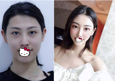 四川美莱熊猛采用新品长效脂肪胶给做的自体脂肪面部填充案例效果分享 