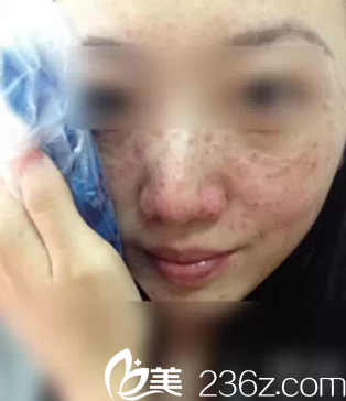 刚做完激光祛斑效果明显 刚做完激光祛斑效果明显