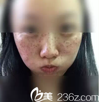 激光祛斑6天后结痂 激光祛斑6天后结痂