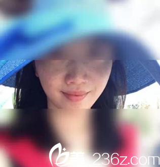 术前雀斑严重 术前雀斑严重