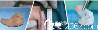 自体软骨隆鼻的材料 自体软骨隆鼻的材料