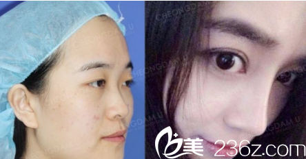 全肋骨隆鼻修复案例一 全肋骨隆鼻修复案例一