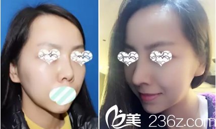 宝妈不满意鼻尖做的修复 宝妈不满意鼻尖做的修复