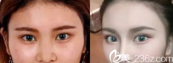 田秋梅医生鼻综合代表案例