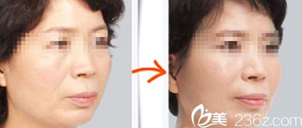 胡庆旭医生面部除皱前后效果对比图