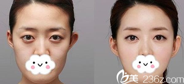 薇琳整形医院V脸提升案例赏析