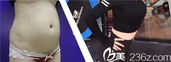 成都市西区医院毛健清腰腹吸脂案例 成都市西区医院毛健清腰腹吸脂案例