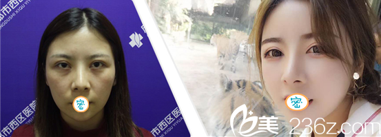 毛建清脂肪填充面部术后反馈 毛建清脂肪填充面部术后反馈