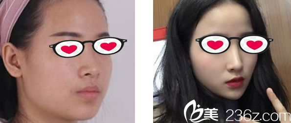 酒泉华美鼻综合隆鼻前后对比图