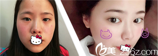 成都西区医院车红昌做双眼皮好吗?真实案例效果展示 成都西区医院车红昌做双眼皮好吗?真实案例效果展示