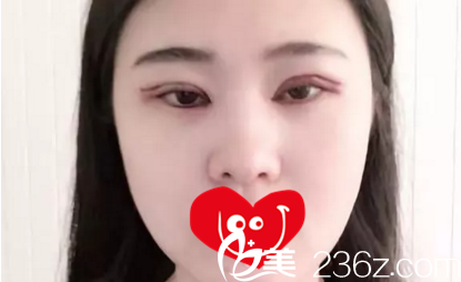割双眼皮术后第二天效果