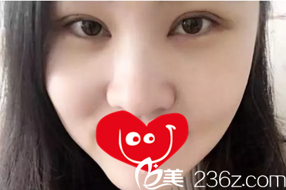 割双眼皮术后第5天时的效果