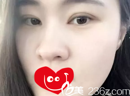 在大连个双眼皮术后半个月效果