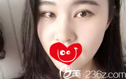 在大连新华美天做双眼皮第22天效果