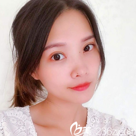 在广州天姿整形医院做完双眼皮一个月自拍 在广州天姿整形医院做完双眼皮一个月自拍