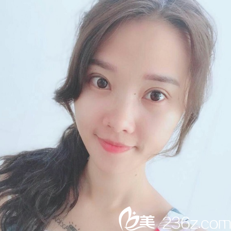看到闺蜜找广州天姿整形医院院长做的双眼皮后我也心动了