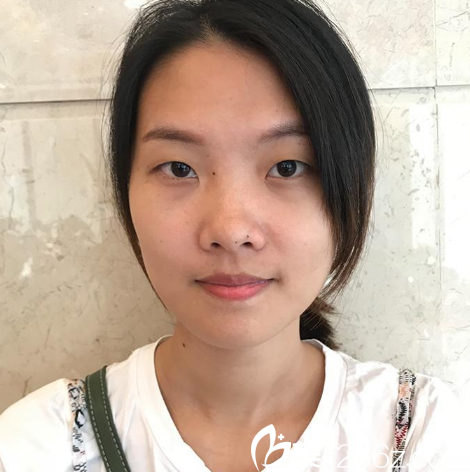 在广州天姿整形医院做双眼皮手术前 在广州天姿整形医院做双眼皮手术前