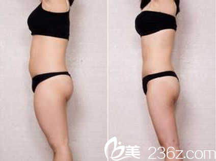 成都西区医院全身吸脂案例对比照 成都西区医院全身吸脂案例对比照