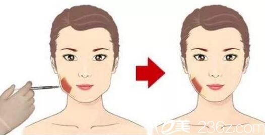 瘦脸的适应症