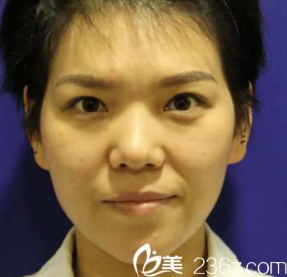 这是做鼻综合之前的我 这是做鼻综合之前的我