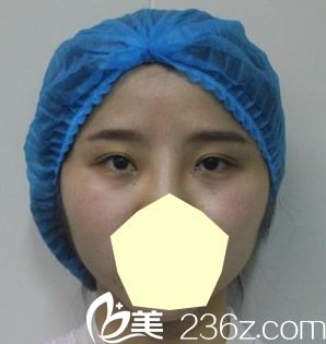 去合肥壹加壹找孟松做埋线双眼皮失败未修复前的样子 去合肥壹加壹找孟松做埋线双眼皮失败未修复前的样子