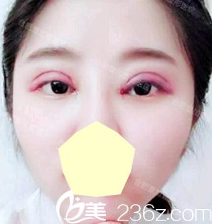 孟松给我做眼部失败修复术后第1天恢复情况 孟松给我做眼部失败修复术后第1天恢复情况