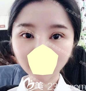 合肥壹加壹双眼皮失败修复术后第5天恢复效果 合肥壹加壹双眼皮失败修复术后第5天恢复效果