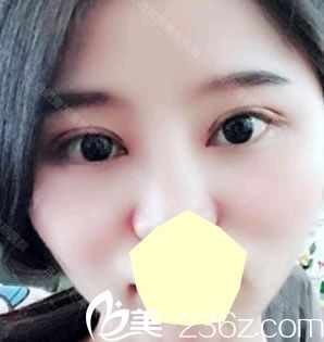 壹加壹孟松修复失败双眼皮术后第7天效果图 壹加壹孟松修复失败双眼皮术后第7天效果图