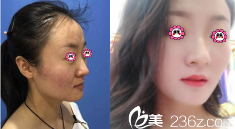 北京美耀天下医疗美容医院彩光嫩肤案例