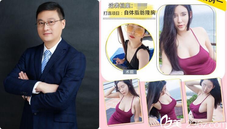 黄名斗医生隆胸案例