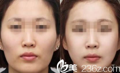 南京维多利亚自体脂肪面部填充案例对比图 南京维多利亚自体脂肪面部填充案例对比图