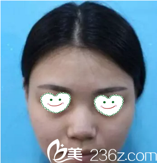 做鼻综合术前照 做鼻综合术前照