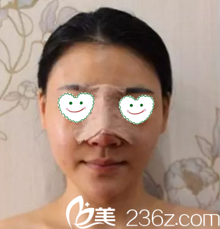 鼻综合术后第2天<span style= 鼻综合术后第2天<span style=