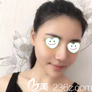 做鼻综合术后一周拆线<span style= 做鼻综合术后一周拆线<span style=