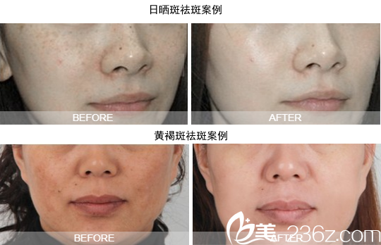 成都艾米丽真实祛斑案例 成都艾米丽真实祛斑案例