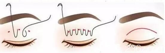 埋线双眼皮好吗？