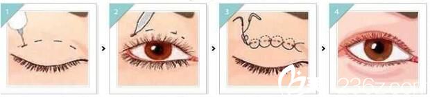 埋线双眼皮术后注意事项