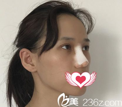 在合肥台美丽格整形做鼻综合术后即刻照片
