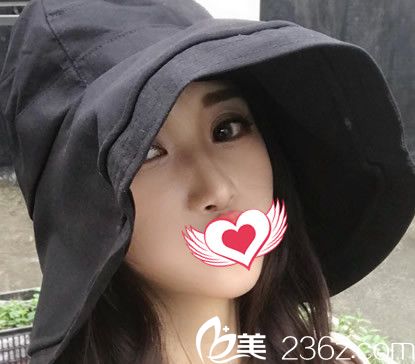 合肥台美丽格整形假体隆鼻鼻综合术后第7天恢复情况