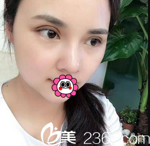 <!--<i data=20240703-sp></i>-->切开双眼皮假体隆鼻案例